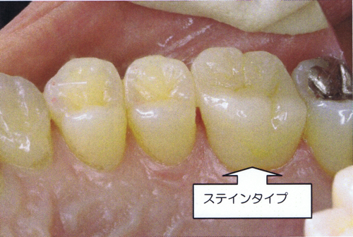 E-maxXeC^Cv