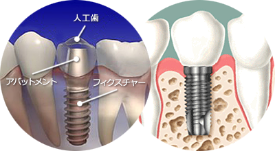 インプラント